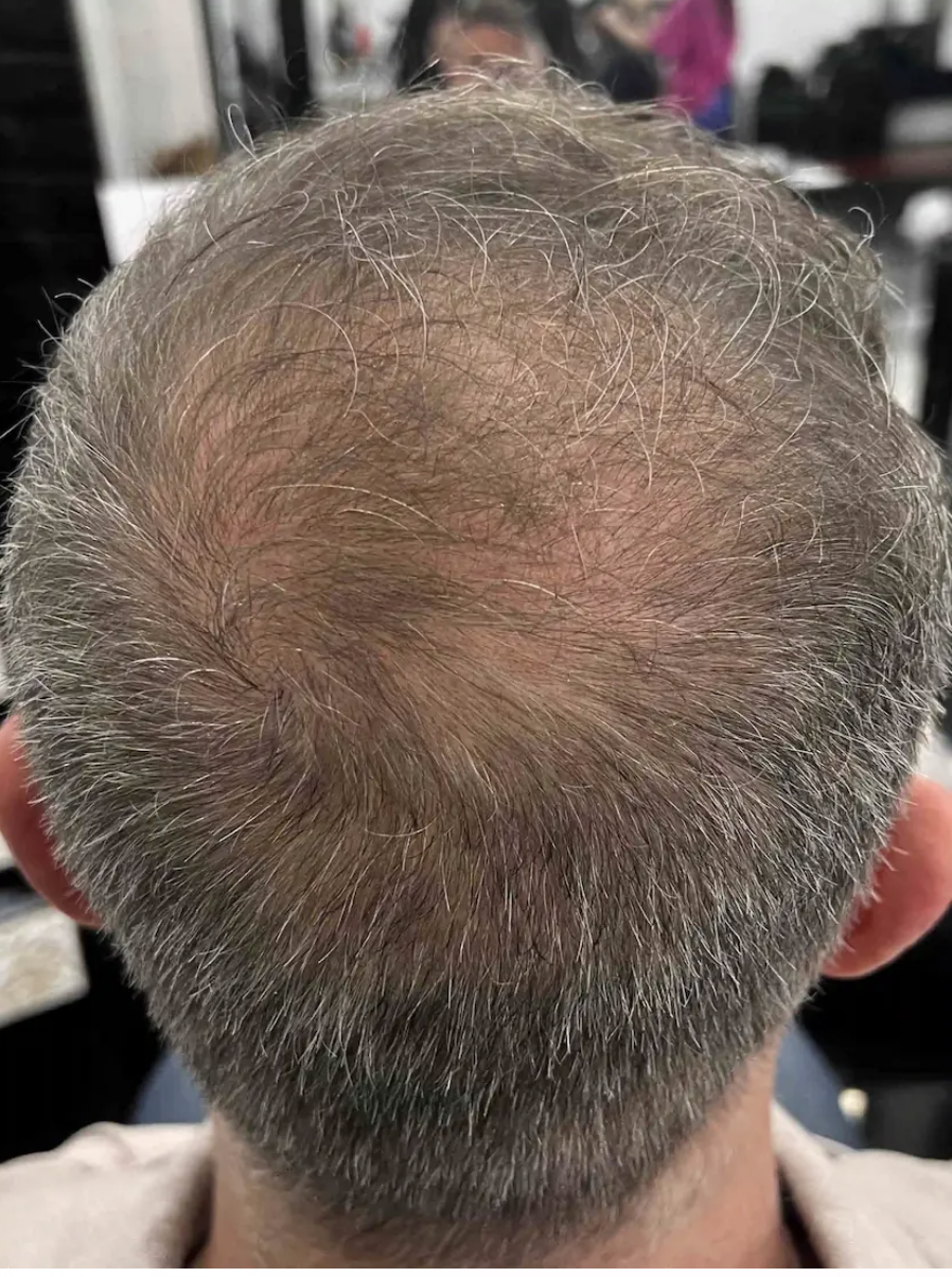 Before hair regrowth treatment