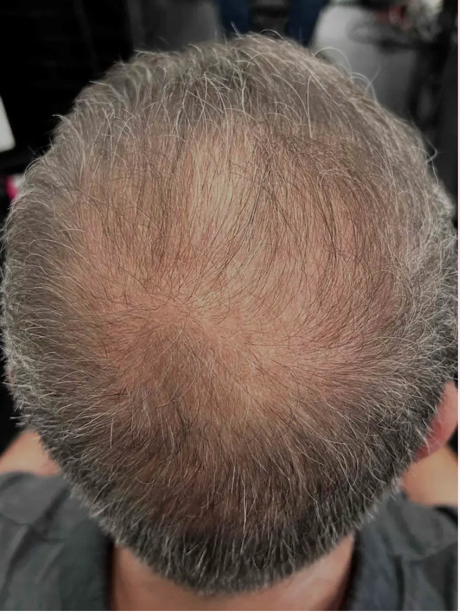 After hair regrowth treatment